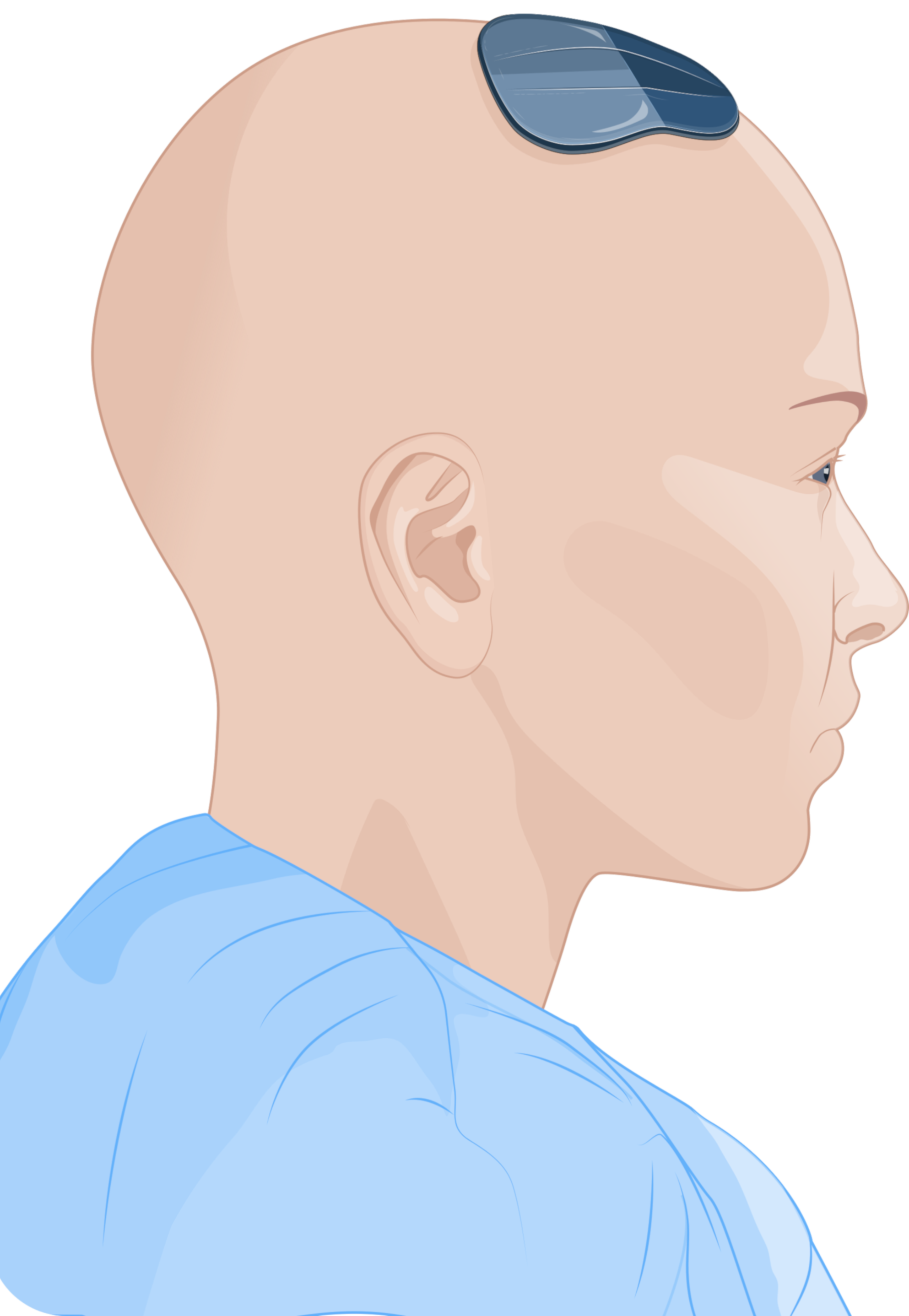 ABILITY implant - view 1